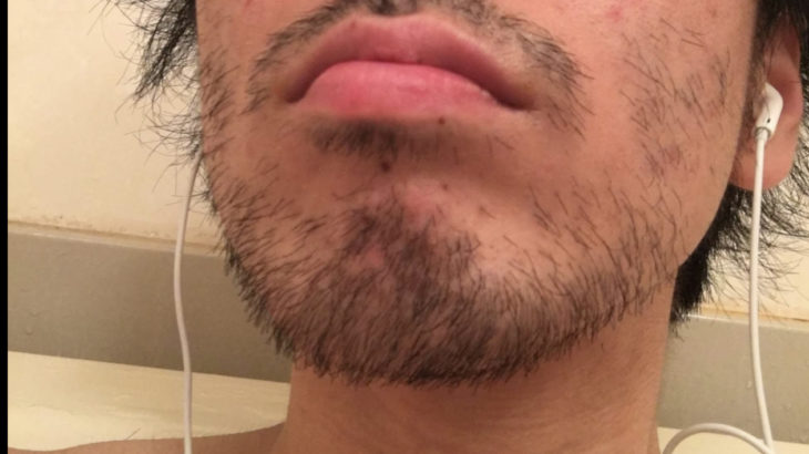 【※閲覧注意】比較画像・料金公開あり 美容投資100万男が教える！ヒゲ脱毛大全